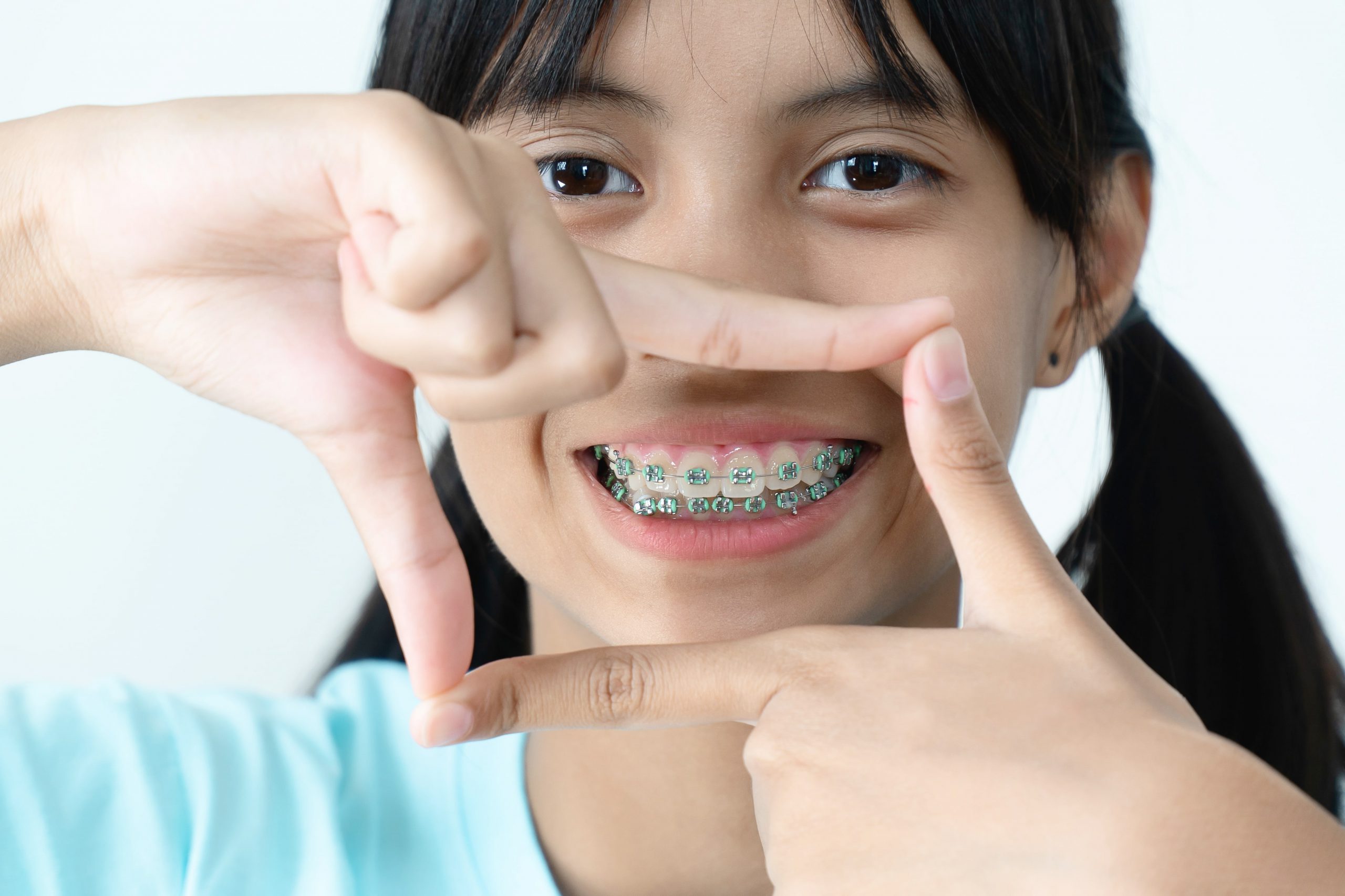 Orthodontics treatment – Everything about braces