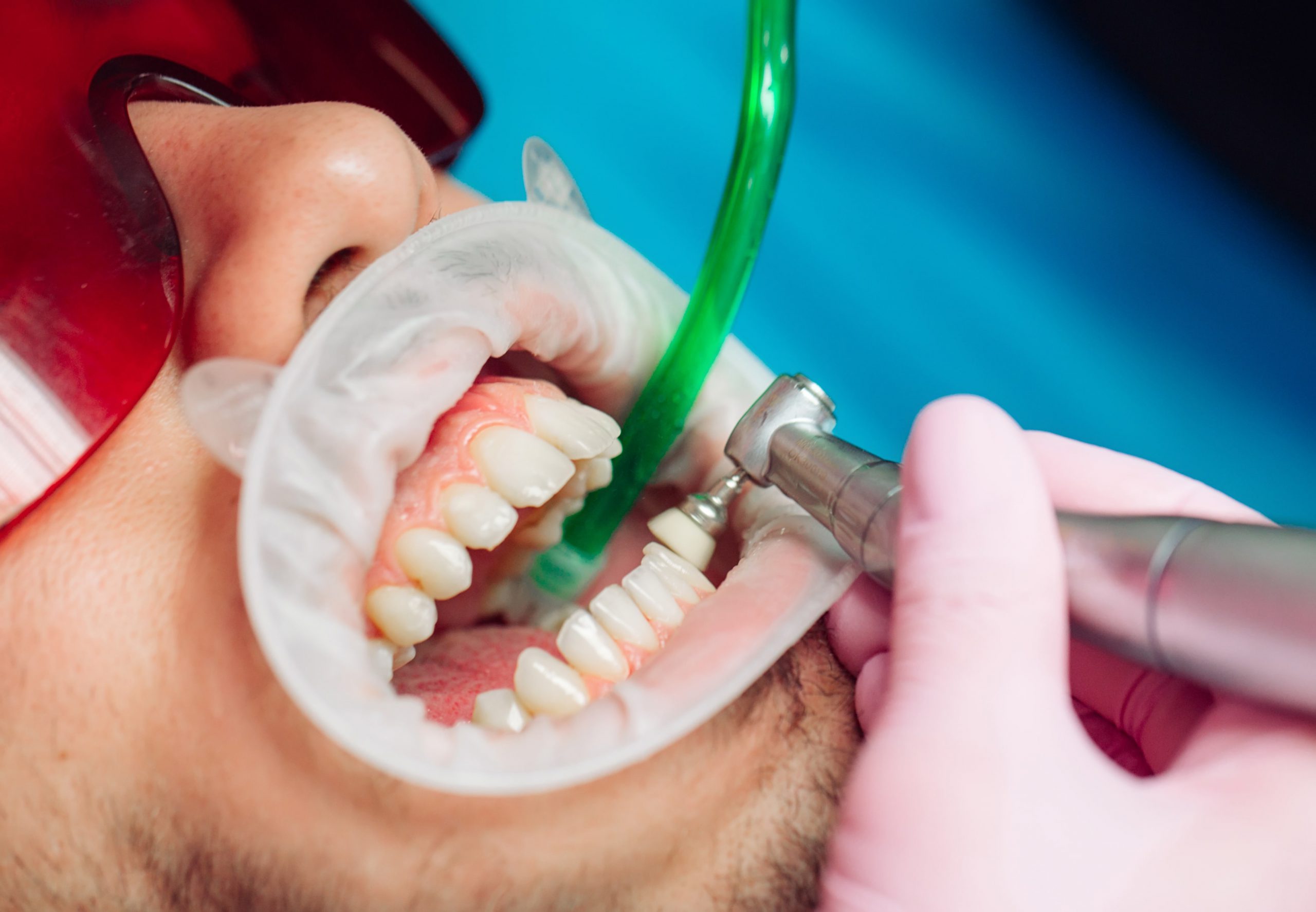 Learn more about Deep Cleaning :Teeth Scaling