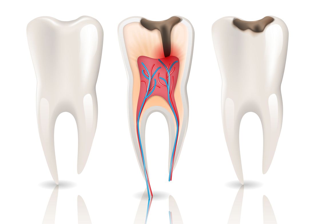 How to identify and treat a Dead tooth?