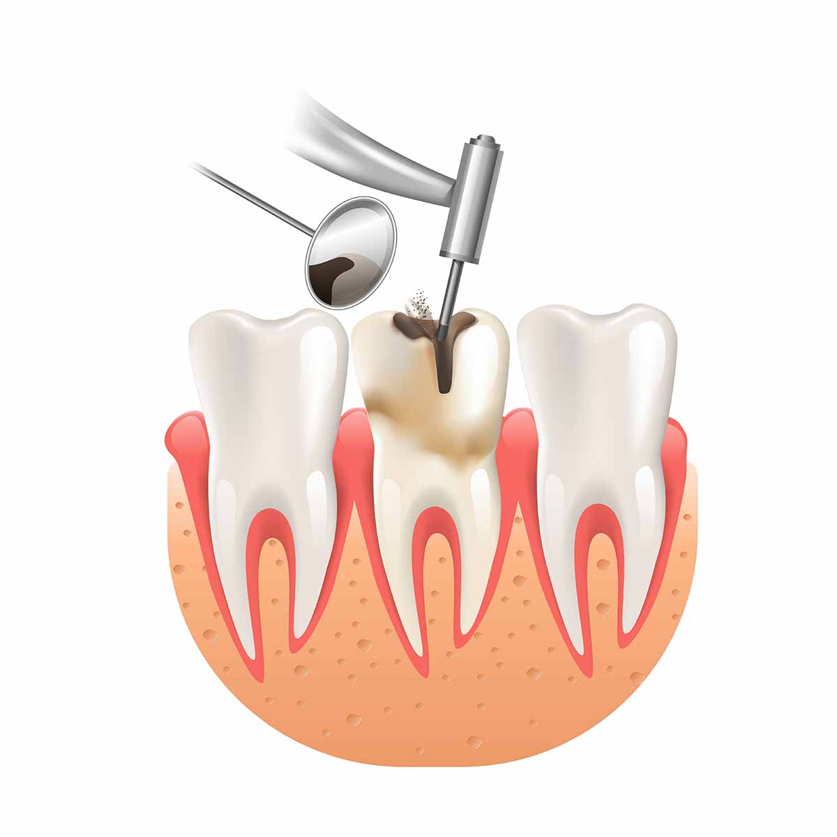 Dental filling