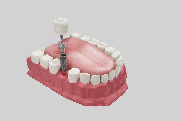 Debunking myths about Dental Implants