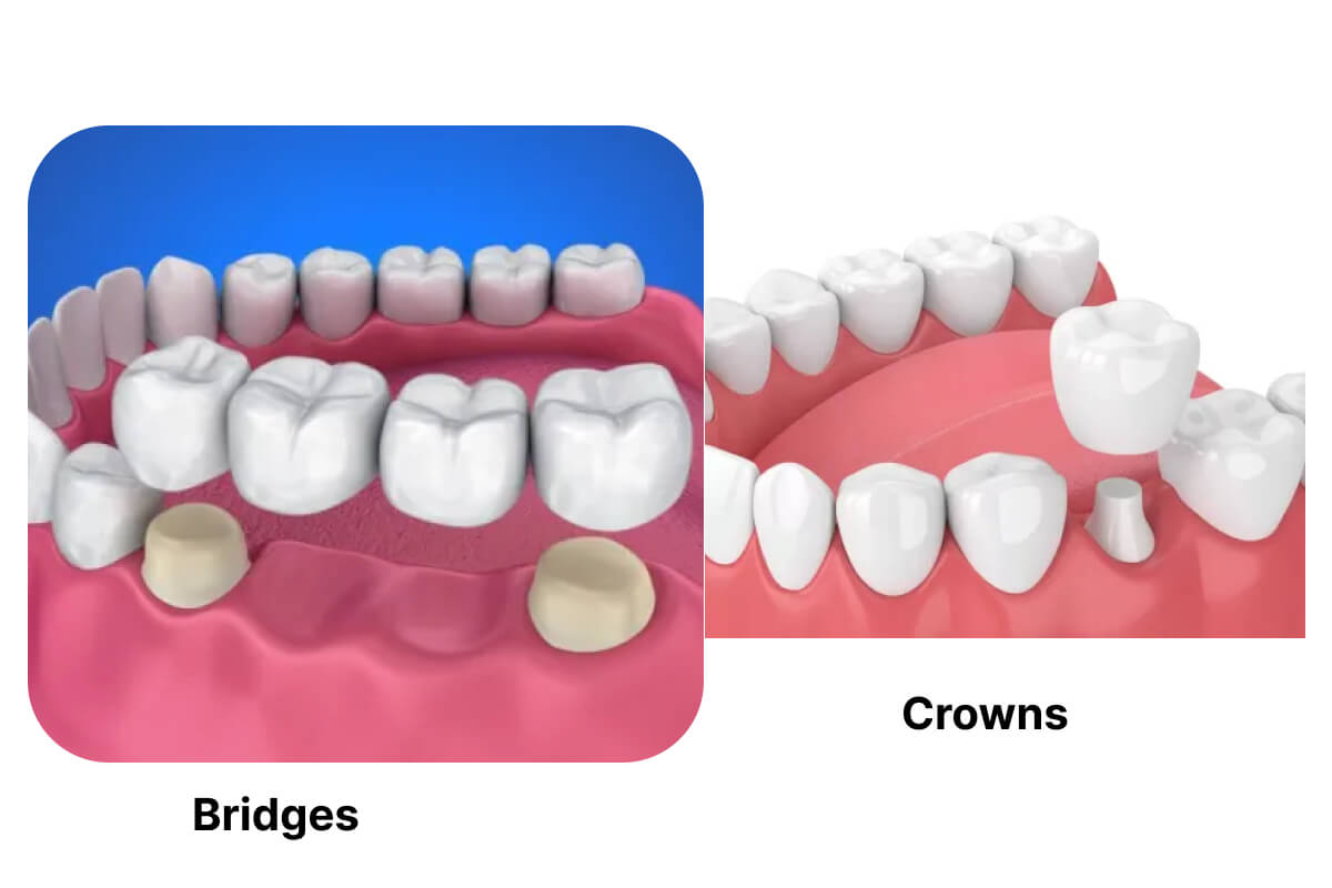 Bridges & Crowns: A Reliable Way to Restore Your Smile