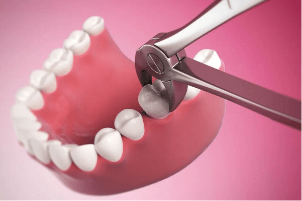 Wisdom tooth removal