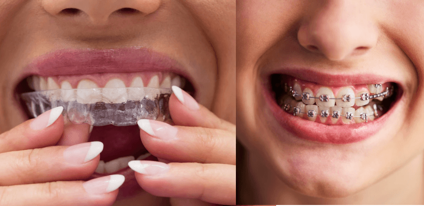 Braces vs. Invisalign: Which Option is Right for You?