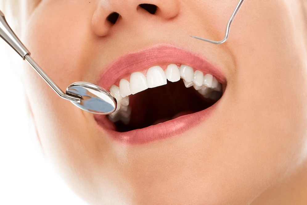 Smile Makeover
