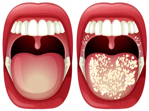 mouth ulcer
